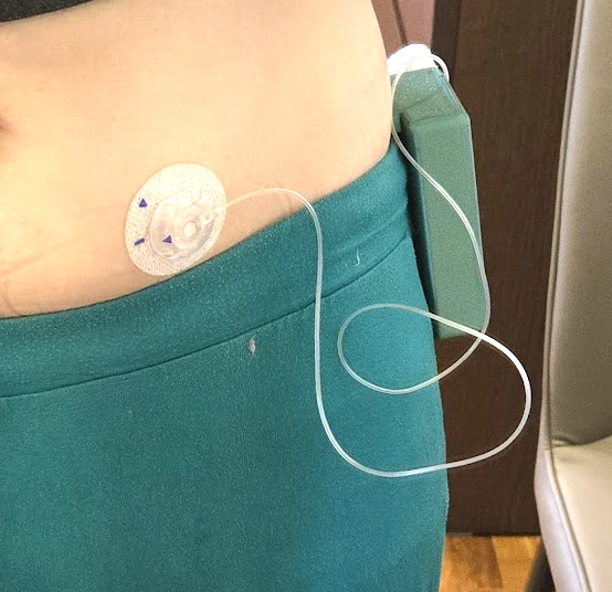 3D printed insulin pump
